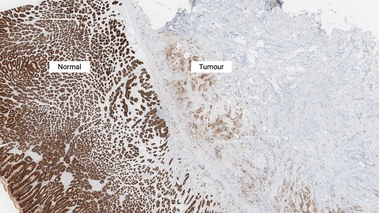2x magnification of CLDN18-stained normal gastric epithelium and tumour cells.